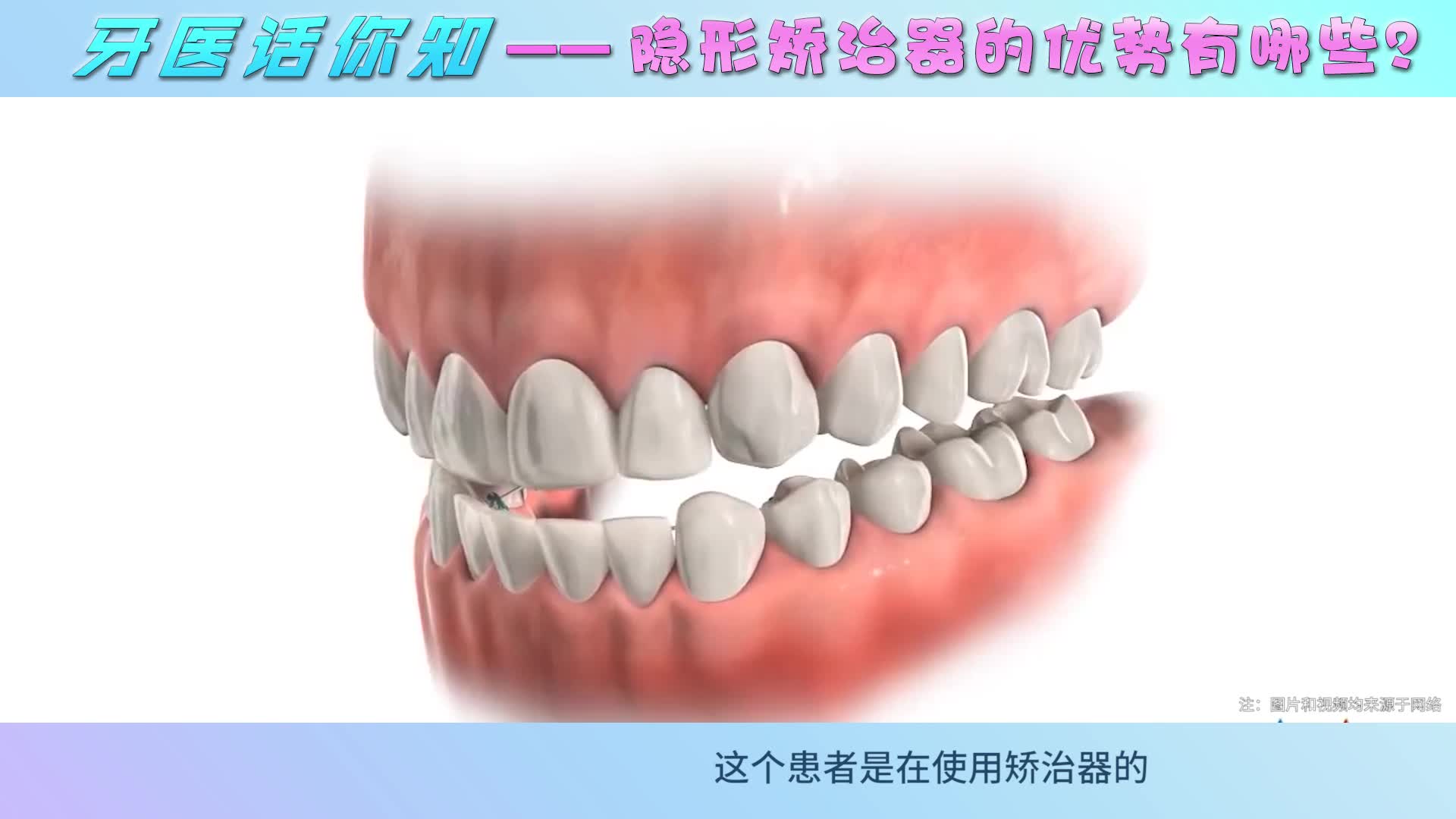 越来越多人喜欢的隐形矫正，好处都有哪些？正畸专家告诉你答案！